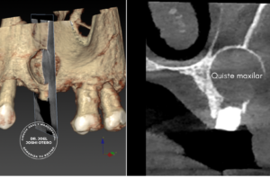 Quiste maxilar Dr. Joshi