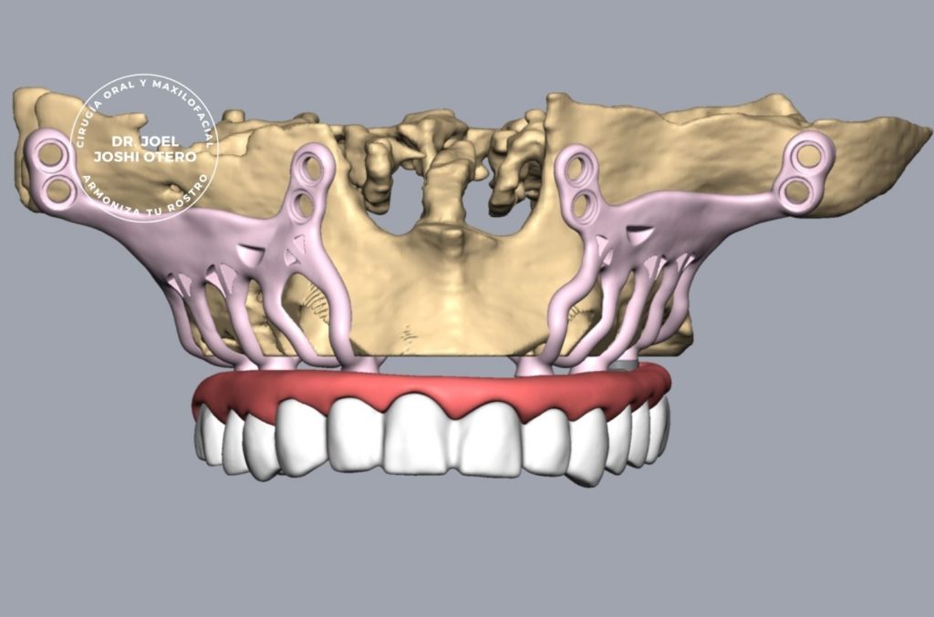 Implantes monocorticales